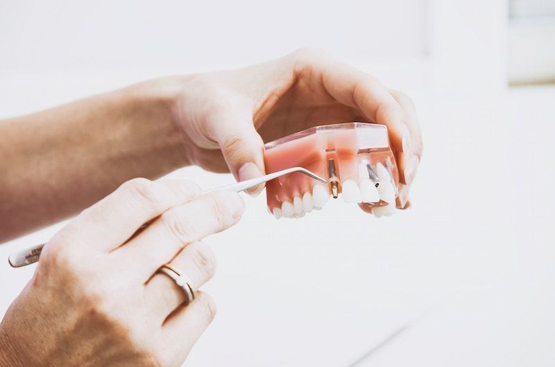 How Dentures Can Change Your Smile